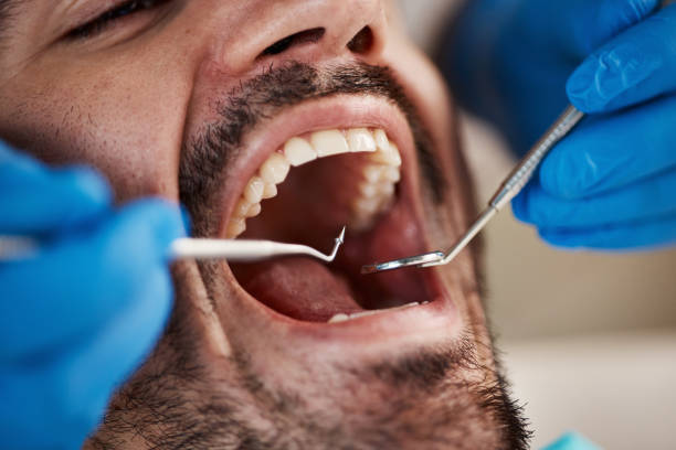Best Chipped Tooth Repair Near Me  in Beavercreek, OH